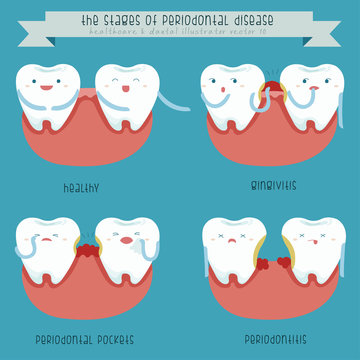The stages of periodontal disease