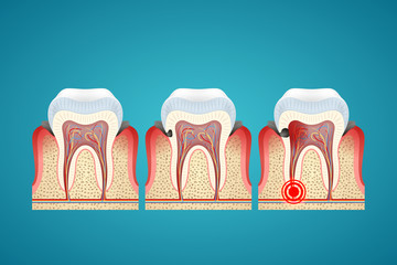 Stages progress caries on human teeth and disease gum