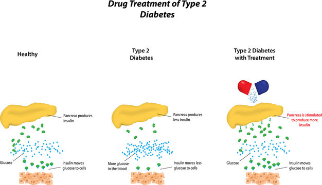 Drug Treatment of Type 2 Diabetes