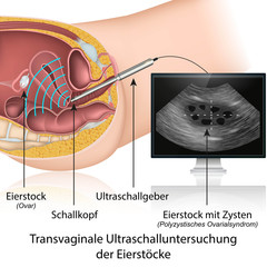 Transvaginale Ultraschalluntersuchung der Eierstöcke