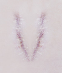 Scar letter V on human skin