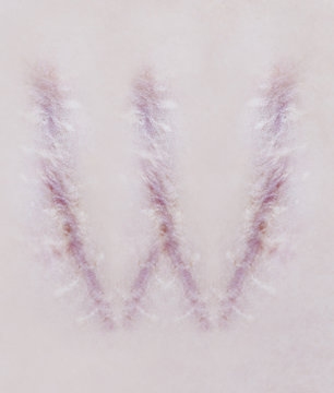 Scar letter W on human skin
