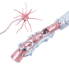 Entzündung und Vernarbung der Myelinscheide - 3D Illustration