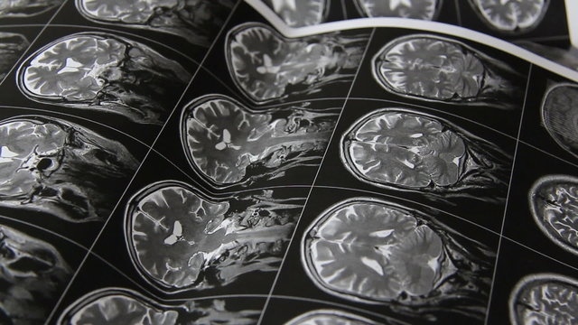MRI Aufnahmen werden beseite geschoben