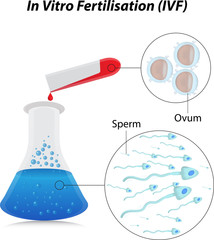 In Vitro Fertilisation