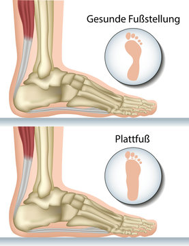 Plattfuß, Anatomie Fuß