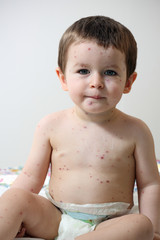 Chickenpox and baby