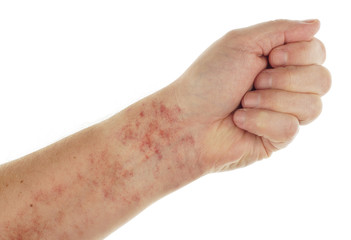 Forearm showing Capillaritis by Leaking Capillaries