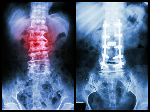 "Spondylosis" (Left image) , internal fixation. (Right image)