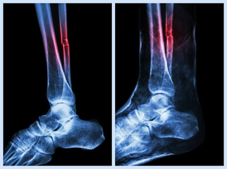 Fracture shaft of fibula (calf bone) and cast