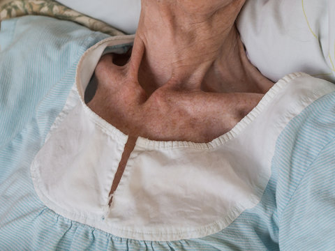 Very skinny old woman lying in a bed