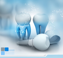 Dental Implant..