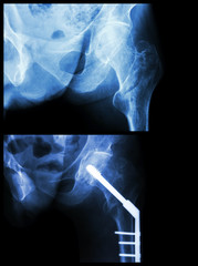 Intertrochanteric fracture left femur (fracture thigh's bone)