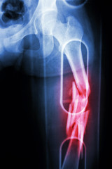 fracture shaft of femur (thigh bone). It was spliced