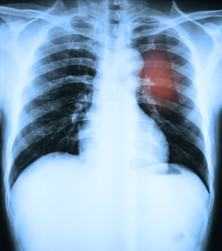 X-Ray Image Of Human Ches tbones for a medical diagnosis