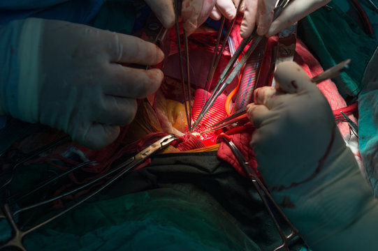 Bentall's operation in ascending aortic aneurysm
