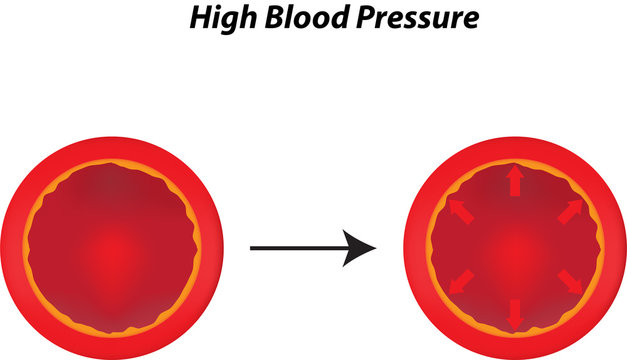 High Blood Pressure