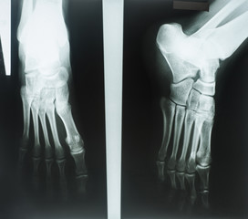 X-rays of human foot