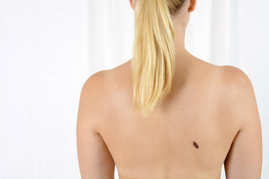 Frau mit Verdacht auf Hautkrebs