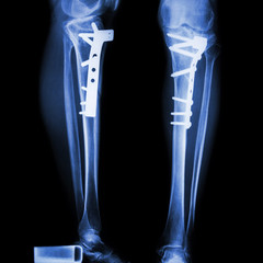 fracture tibia(leg bone). It was operated and internal fixed by