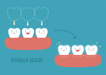 How to of invisible braces by tooth concept Illustrator
