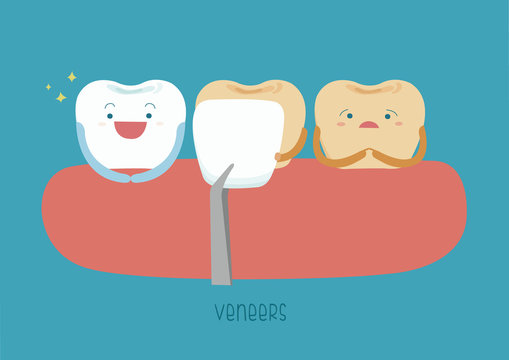 Veneers teeth of dental