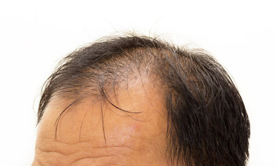 Male head with hair loss symptoms front side