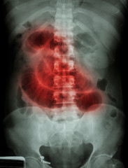 "Small intestine obstruction"  Film X-ray abdomen supine