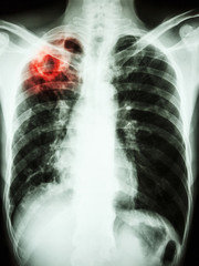 Mycobacterium tuberculosis infection (Pulmonary Tuberculosis)
