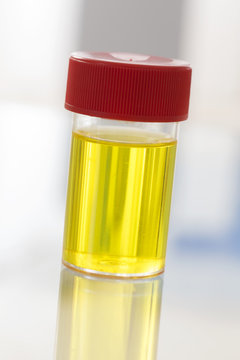 &eacute;chantillon d'urine fra&icirc;che