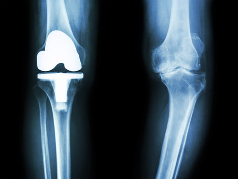 Osteoarthritis Knee Patient And Artificial Joint