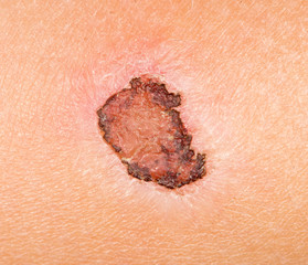 wound on the human skin. close-up