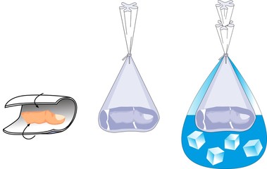 Erste Hilfe / Amputation