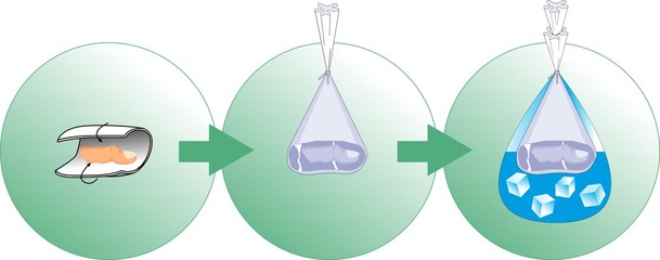 Erste Hilfe / Amputation