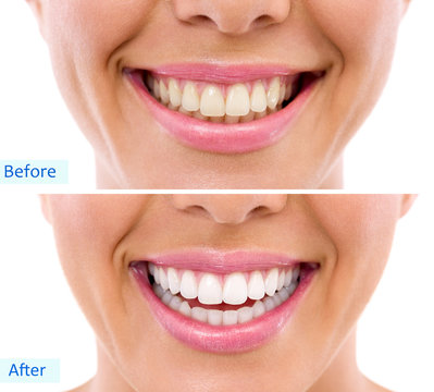 whitening - bleaching treatment ,woman teeth and smile, before a