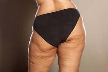 fat female buttocks with cellulite and stretch marks - obrazy, fototapety, plakaty