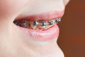 dental braces on teeth of upper jaw close up