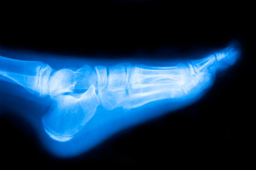 Fototapeta na wymiar x-ray of foot