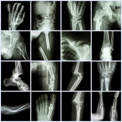 Collection X-ray multiple bone fracture
