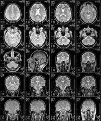 Magnetic resonance imaging