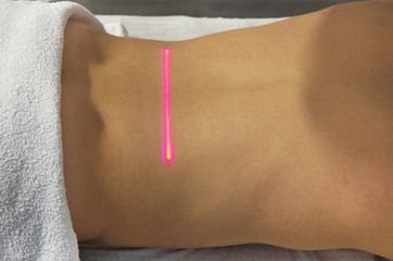Laser Therapy on a back of an young girl