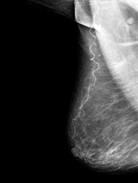 mammography x-ray picture