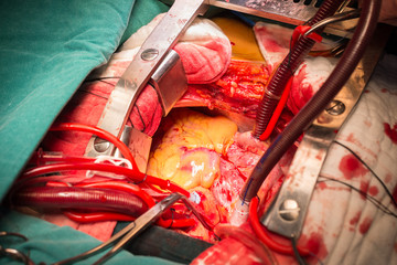 coronary AV fistula RCA to RA
