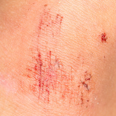 wound on the skin. close-up