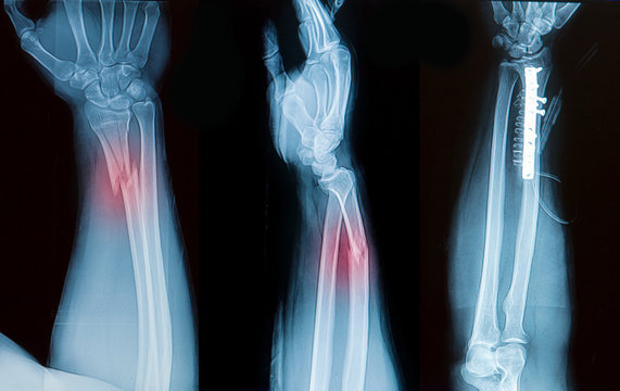 x-ray image of borken forearm bone show pre- post operation