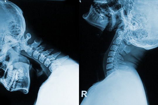 x-ray image of neck show neck pain in flex and exten position