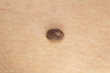 Skin mole