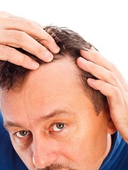 Fototapeta premium Androgenic Hair Loss