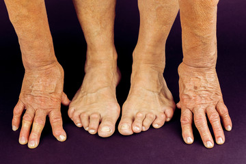 Rrheumatoid arthritis hand and toe deformities