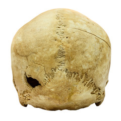 Human Skull Fracture (backside) (,Asian) on isolated b
